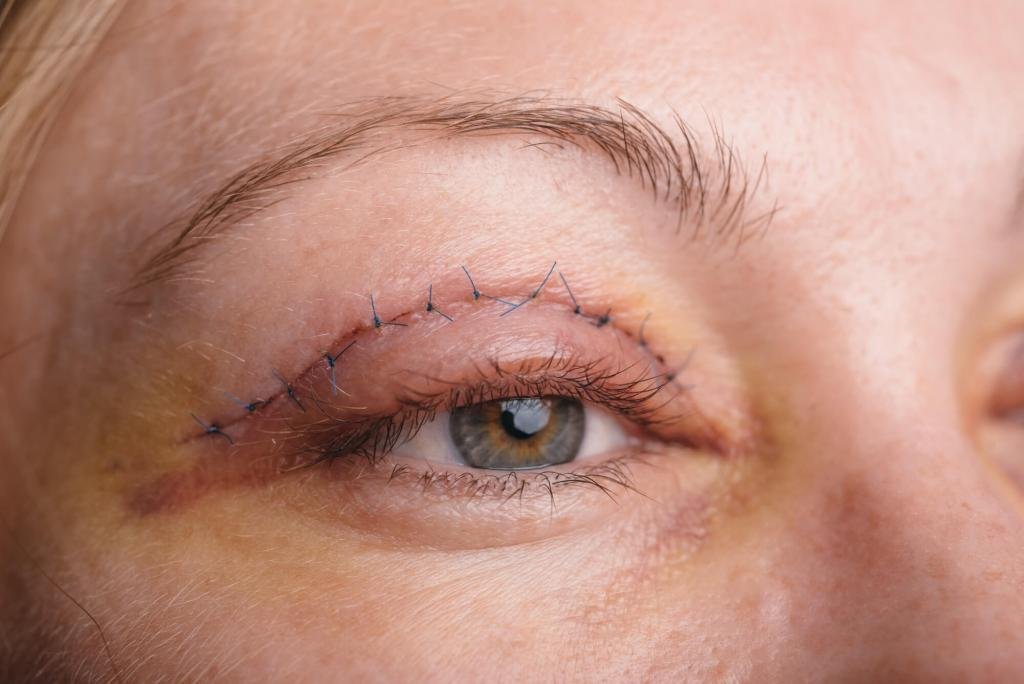 Eyelid Uplift Surgery Consultation